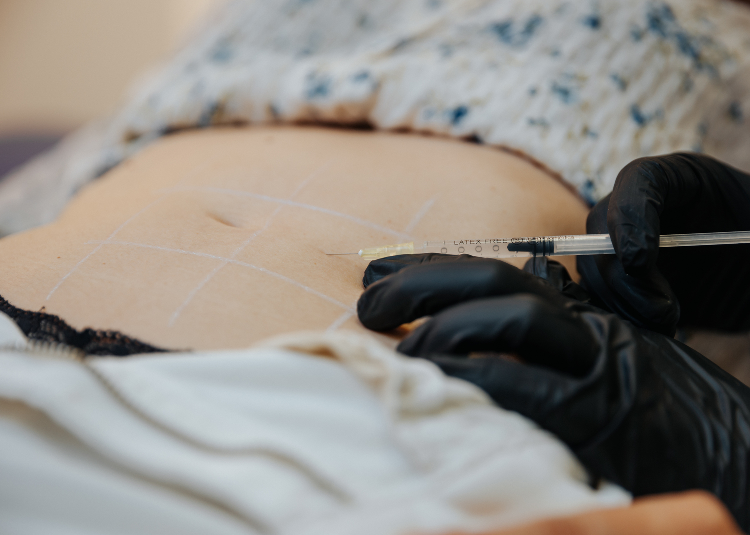 mesoterapia corporal zaragoza