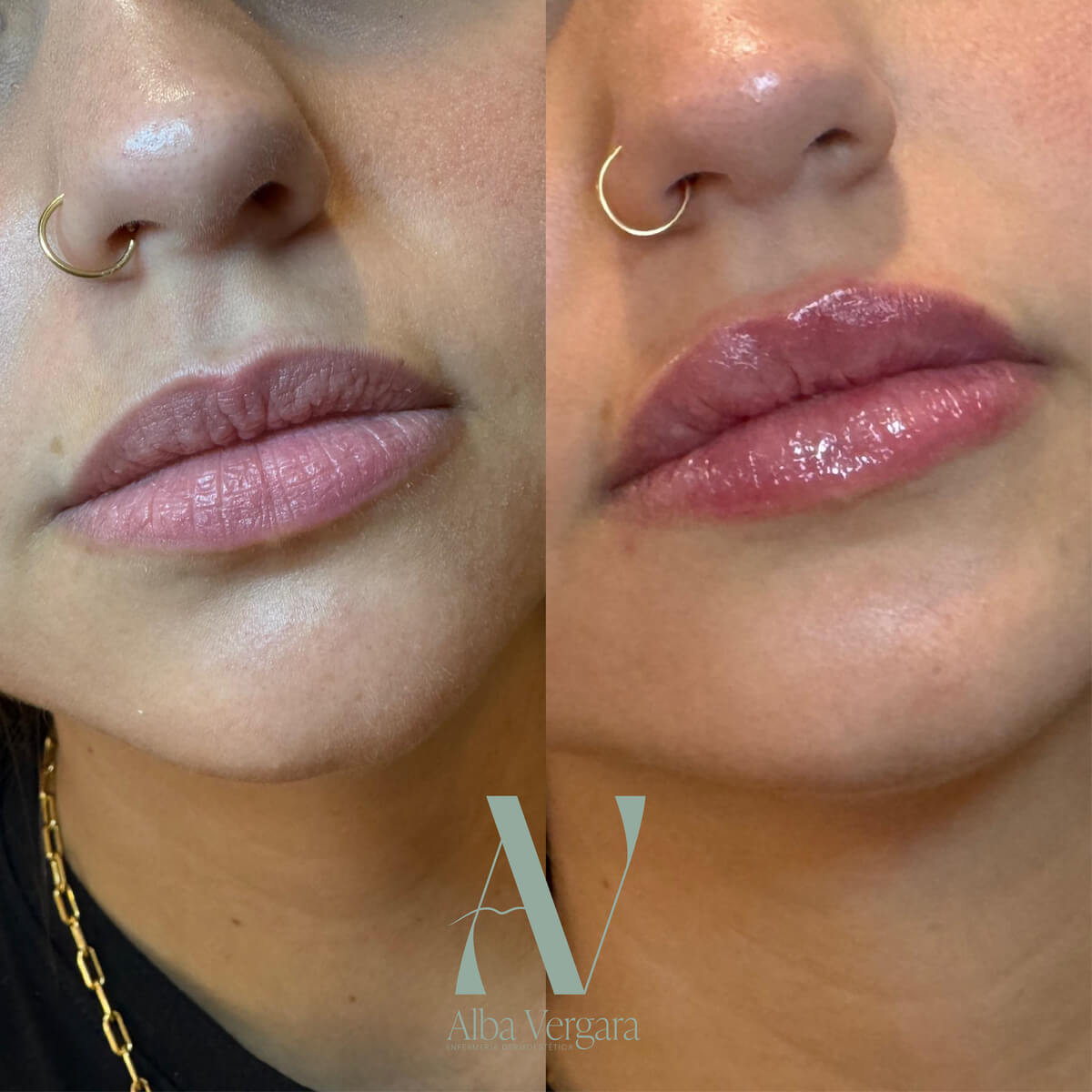 Antes despues labios - Acido Hialuronico en zaragoza